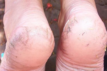 How To Prevent And Treat Cracked Heels